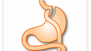 chirurgie Gastrique Bypass