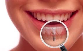 implant dentaire pas cher