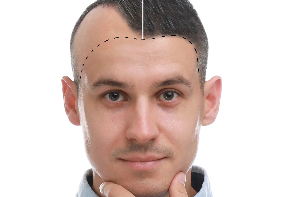 implants-cheveux